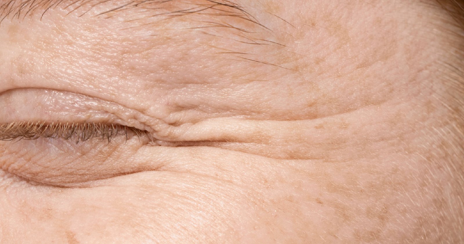 Botox in Bangalore